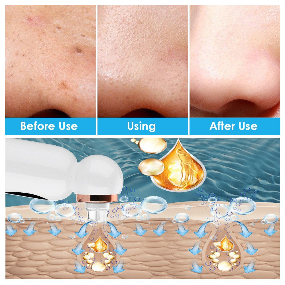 PureSkin Pro | Hydrodermabrasion | Mitesserentferner | Tiefenpflege
