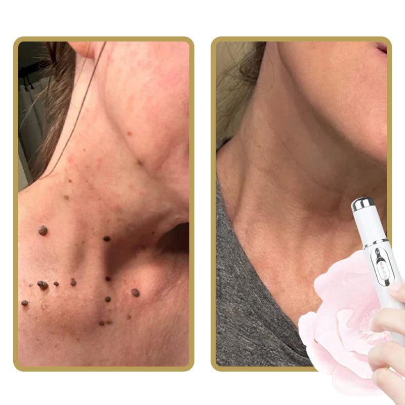 ClearDerm - Schmerzfreie Pickelentfernung für schnelle, glatte Haut