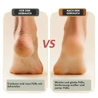 SmoothSole – Schmerzfreie Füße in nur wenigen Minuten