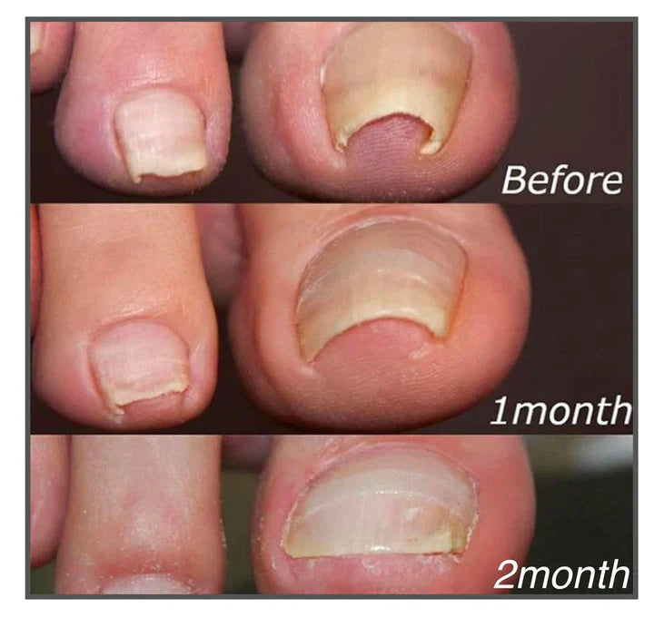 10+10 GRATIS | FixaNail - Sofortige Nagelreparatur