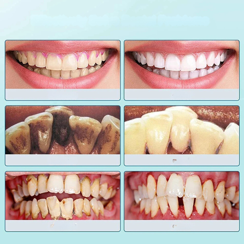 Dentaclear Sonic | Ultraschall Zahnreiniger | Kompakt & Effektiv | Für Zuhause & Reisen
