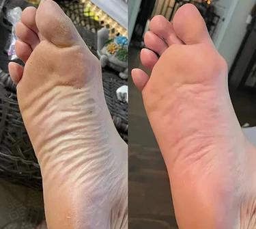 SoftFeet – Samtweiche Füße in Minuten, nicht Wochen!