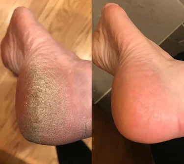 SoftFeet – Samtweiche Füße in Minuten, nicht Wochen!