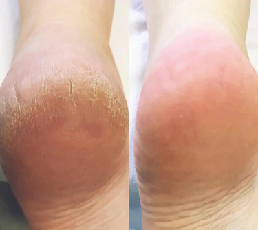 SoftFeet – Samtweiche Füße in Minuten, nicht Wochen!