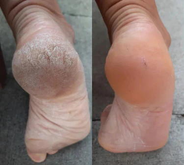 SoftFeet – Samtweiche Füße in Minuten, nicht Wochen!